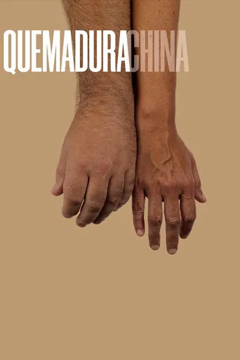 Quemadura china